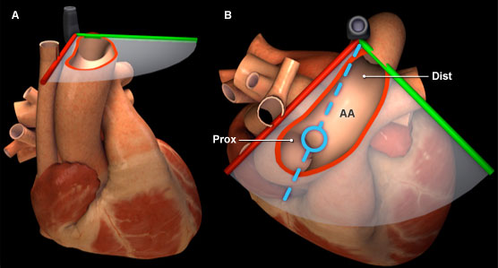 Aortic Arch in 3D