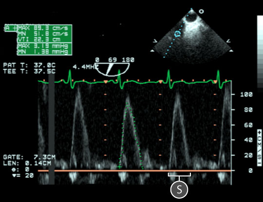 pulsed wave spectral doppler of pulmonary valve