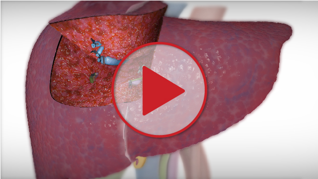 Segment IVa VIII Liver Resection For Hepatocellular Carcinoma HCC Toronto Video Atlas Of