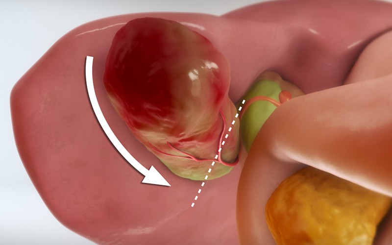 Difficult laparoscopic cholecystectomy: Subtotal cholecystectomy