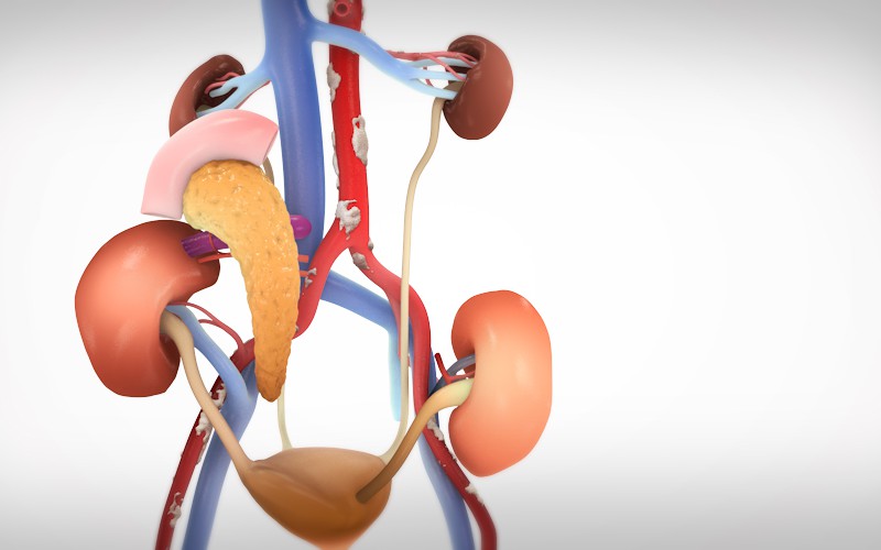 Synchronous pancreas-kidney transplant