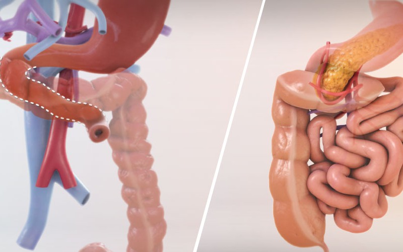 Isolated bowel transplant