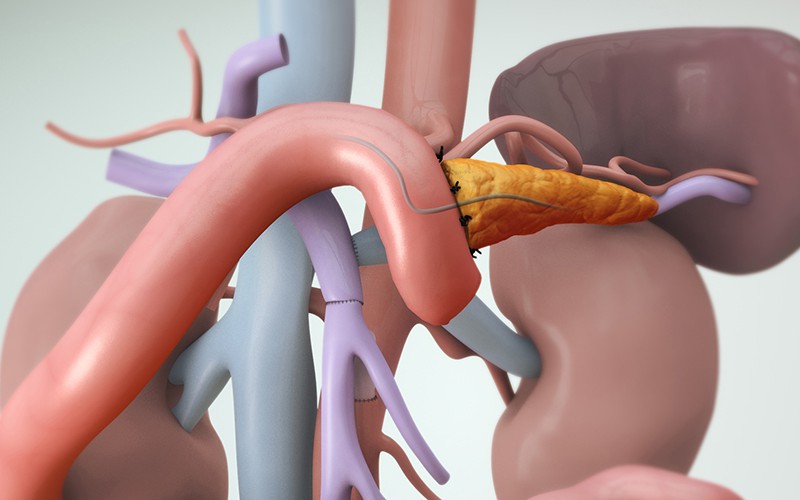 Pancreaticoduodenectomy (Whipple) with SMA and SMV Resection and Reconstruction