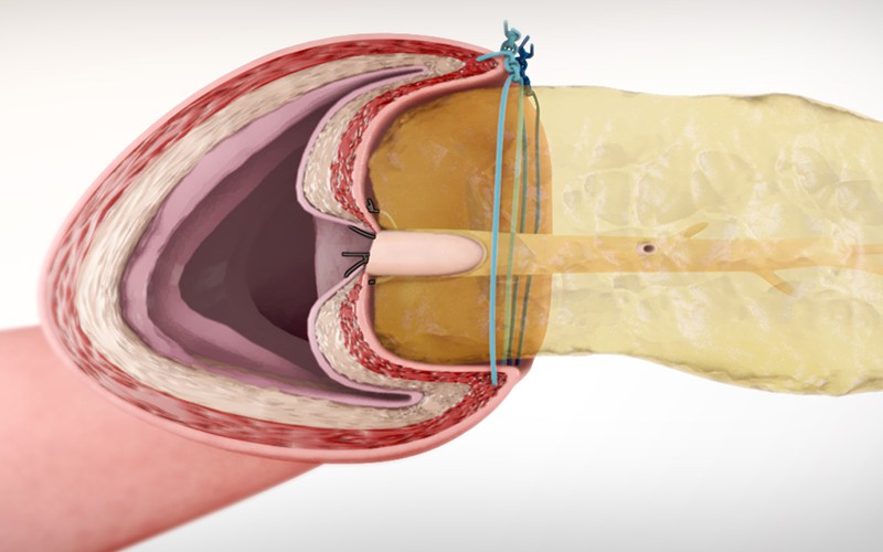 Laparoscopic Blumgart-style pancreaticojejunostomy