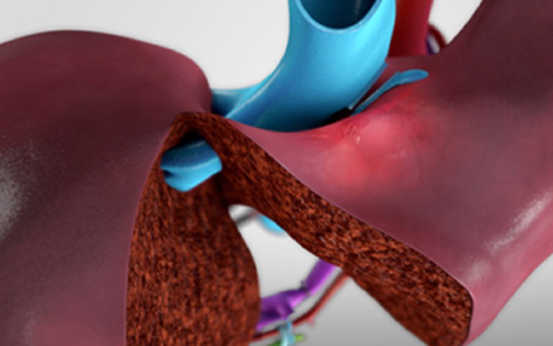 Extended left hepatectomy with in situ cold perfusion