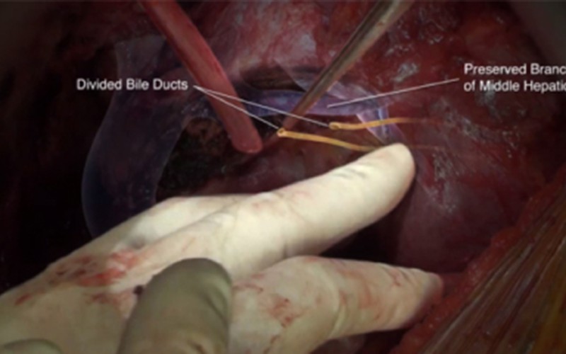 Segment IV resection (redo hepatectomy)