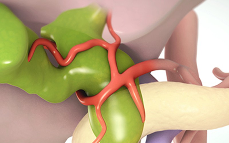 Resection of a Type I choledochal cyst