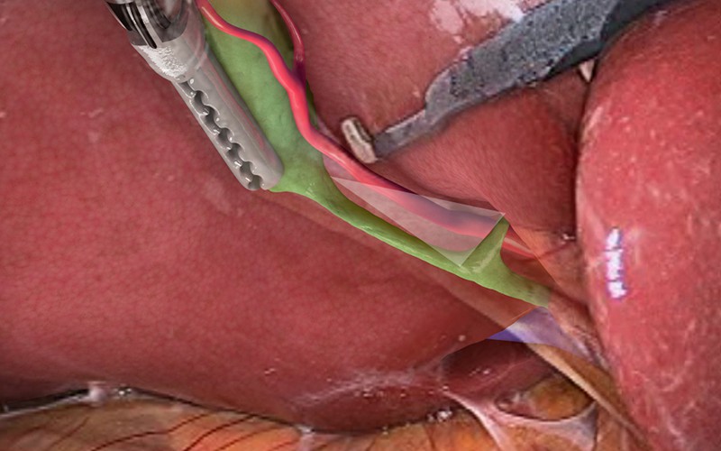 Standard laparoscopic cholecystectomy