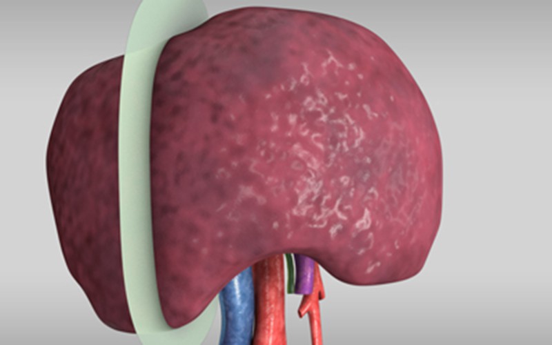 Segment VI/VII segmentectomy