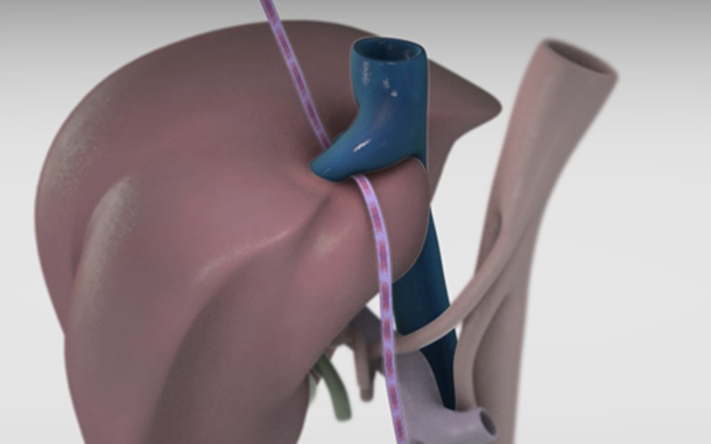 Standard left hepatectomy