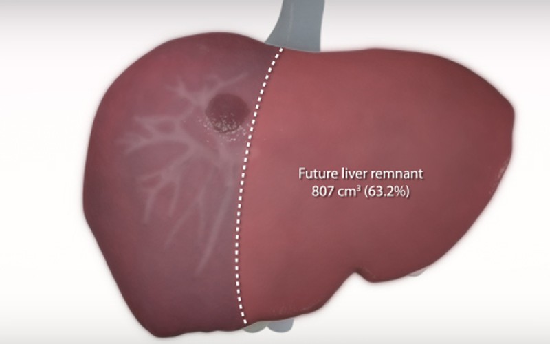 Standard right hepatectomy with portal vein embolization