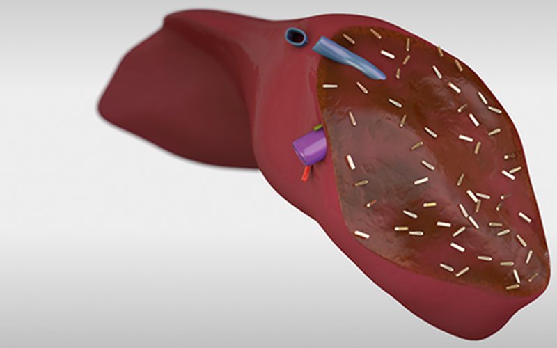 Pediatric liver transplant: Living donor left lateral lobe (recipient procedure)