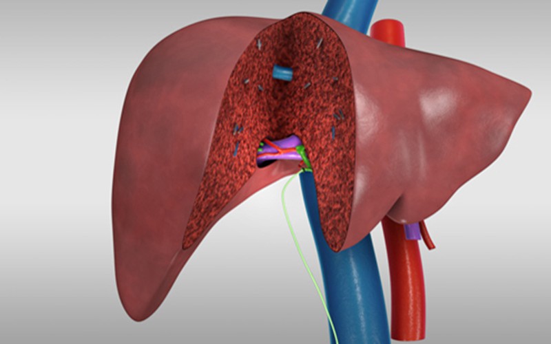 Liver transplant: Living donor right hepatectomy (donor procedure)