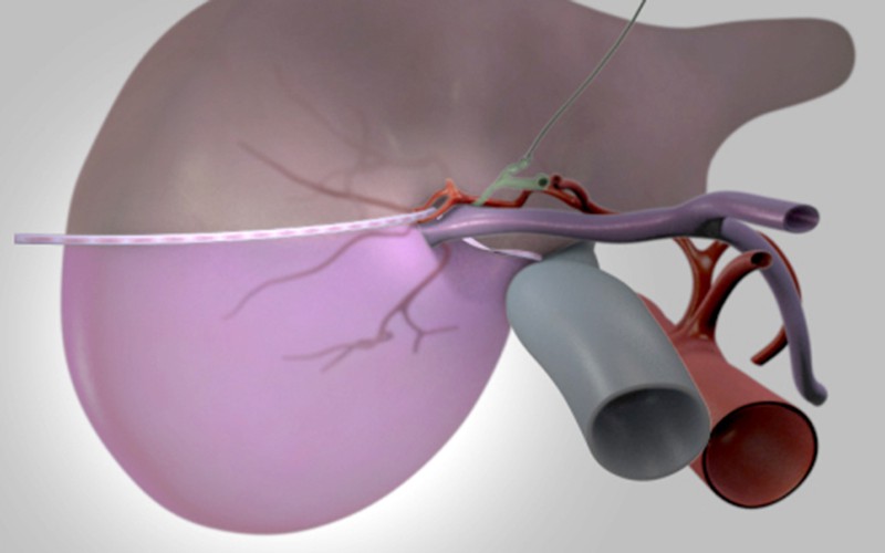 Liver transplant: Living donor right posterior sectionectomy (donor procedure)