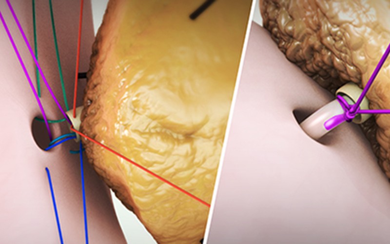 Pancreaticojejunostomy with stent