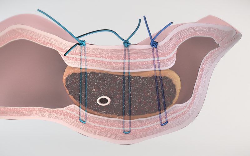 Blumgart-style Pancreaticojejunostomy