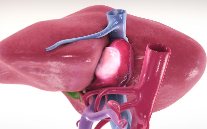 Extended left hepatectomy with caval resection