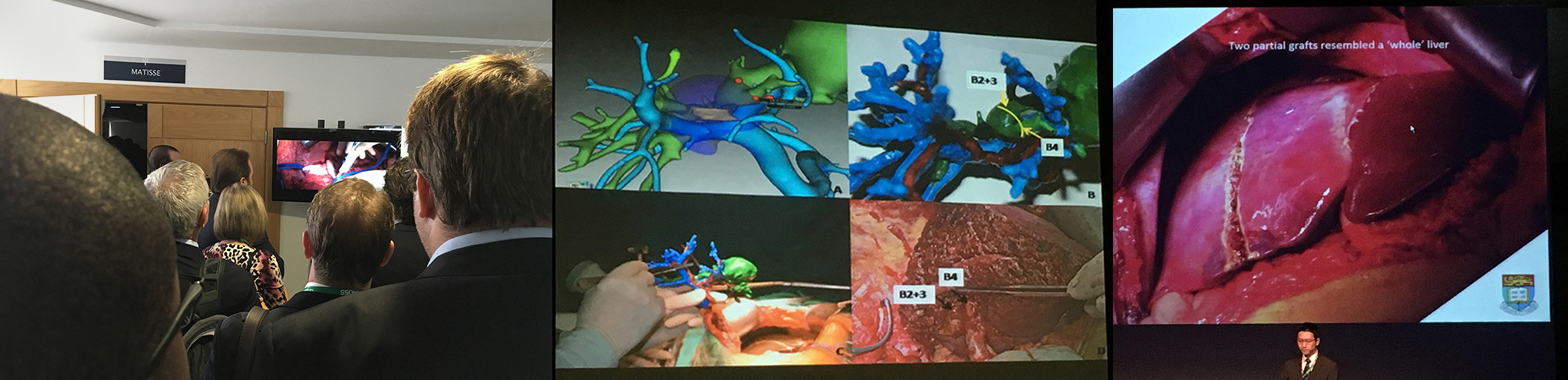 Video session at IHPBA 2016