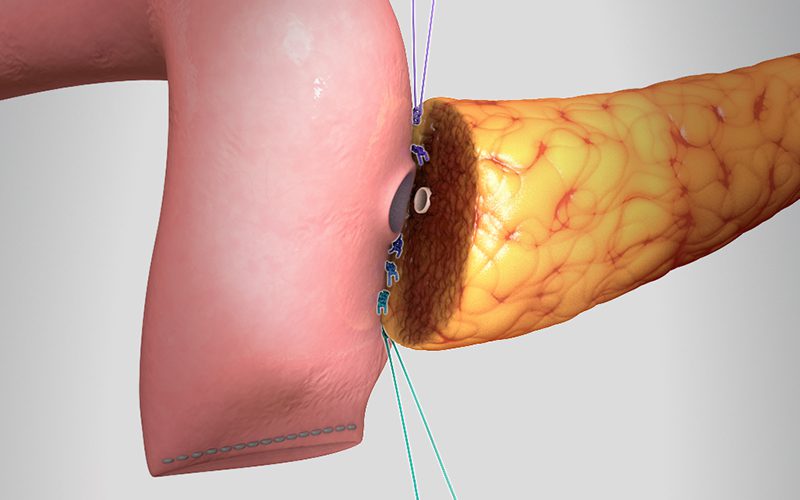 Pancreaticojejunostomy “Dunk” technique