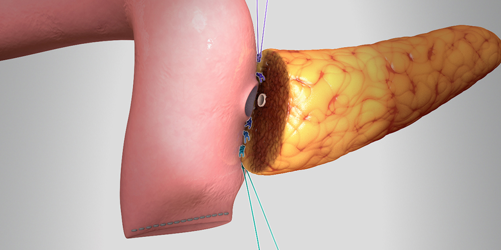 Pancreaticojejunostomy “Dunk” technique