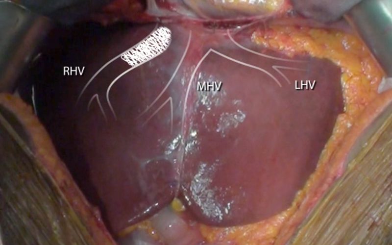 Ex-vivo liver I/VI/VII segmentectomy with en bloc caval resection and right nephrectomy