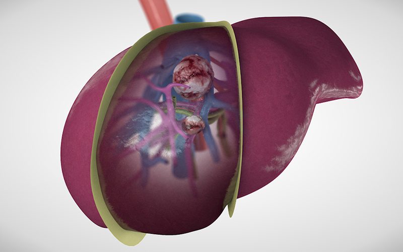 Segment V/VIII mesohepatectomy with extrahepatic pedicle isolation technique