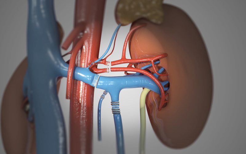 Living donor kidney transplant Part I: Laparoscopic living donor nephrectomy