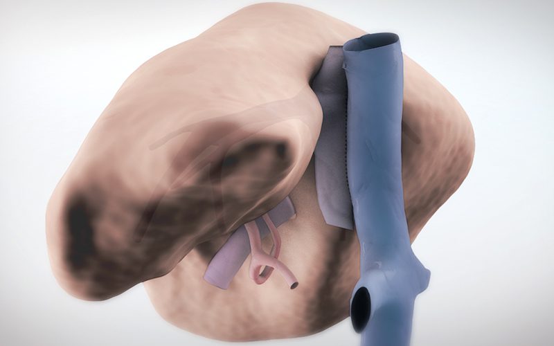 Piggy-back liver transplantation with SMV jump graft