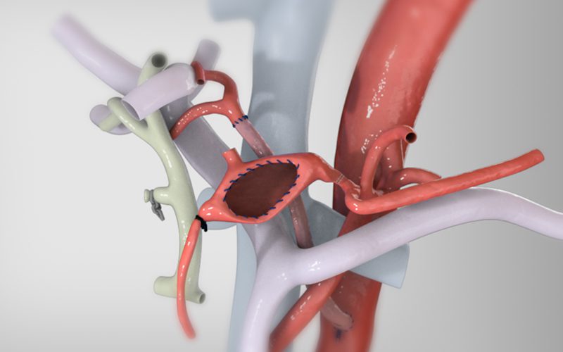 Hepatic artery aneurysm resection and reconstruction