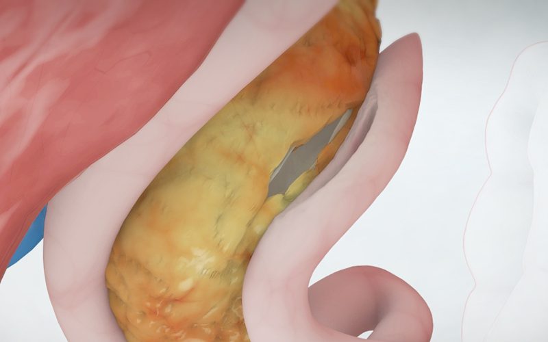 Longitudinal Pancreaticojejunostomy (Puestow Procedure)