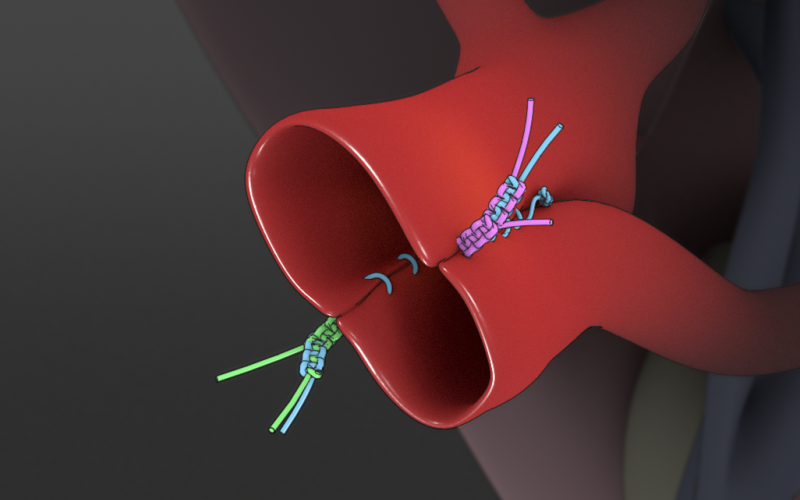 Vascular technique: Side-to-side arterioplasty