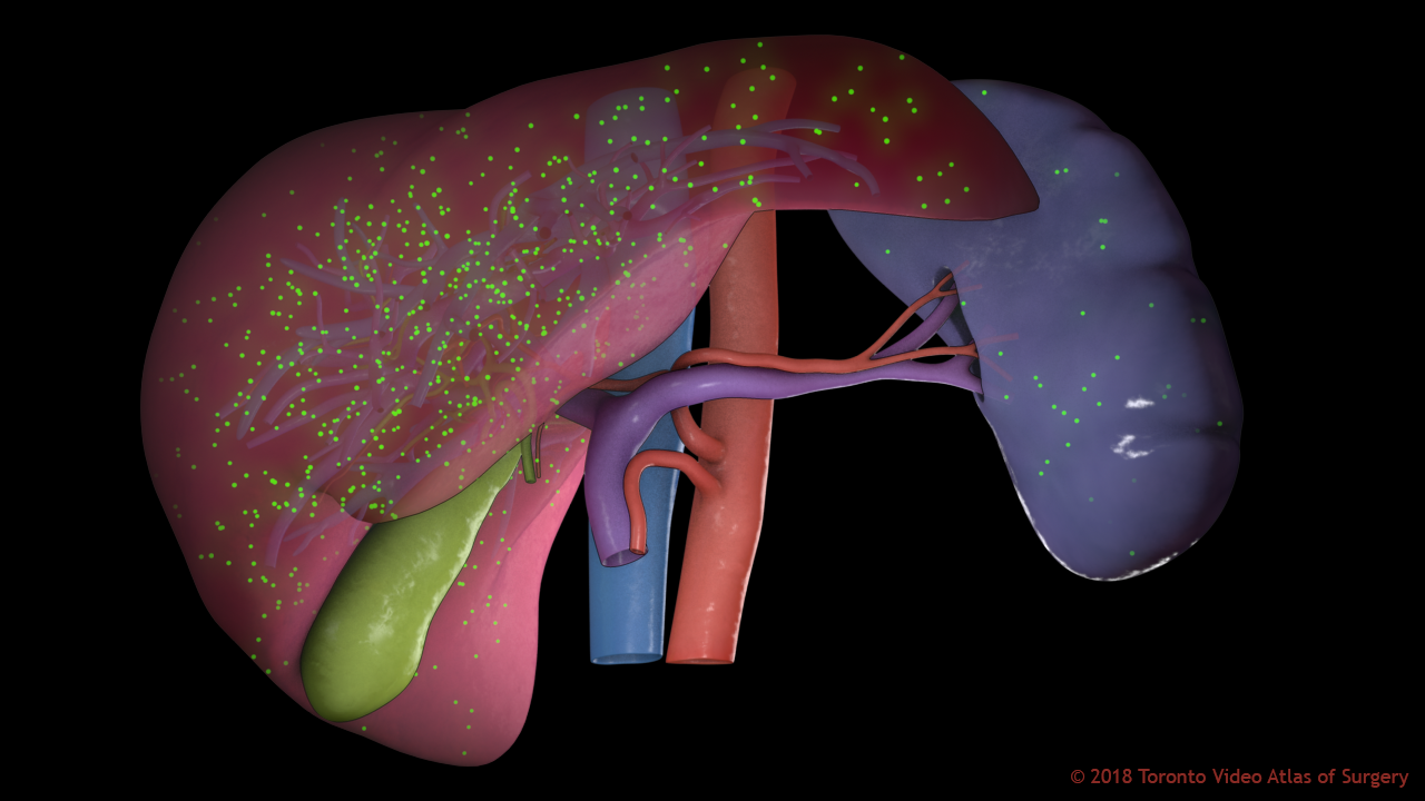 Liver & spleen with nanoparticles