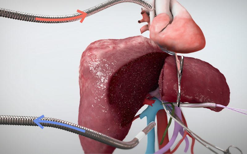 Extended right hepatectomy with veno veno bypass (Part I)