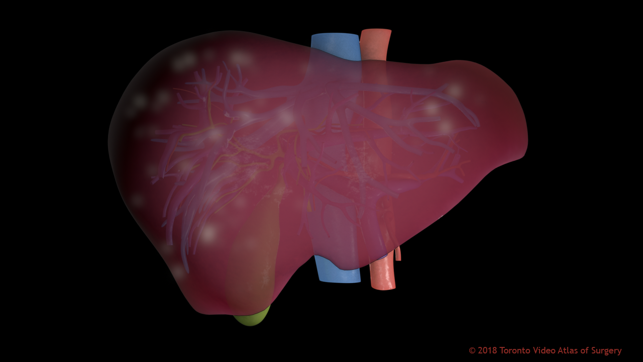 Liver with diffuse tumours