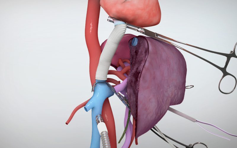 Extended right hepatectomy with veno veno bypass (Part II)