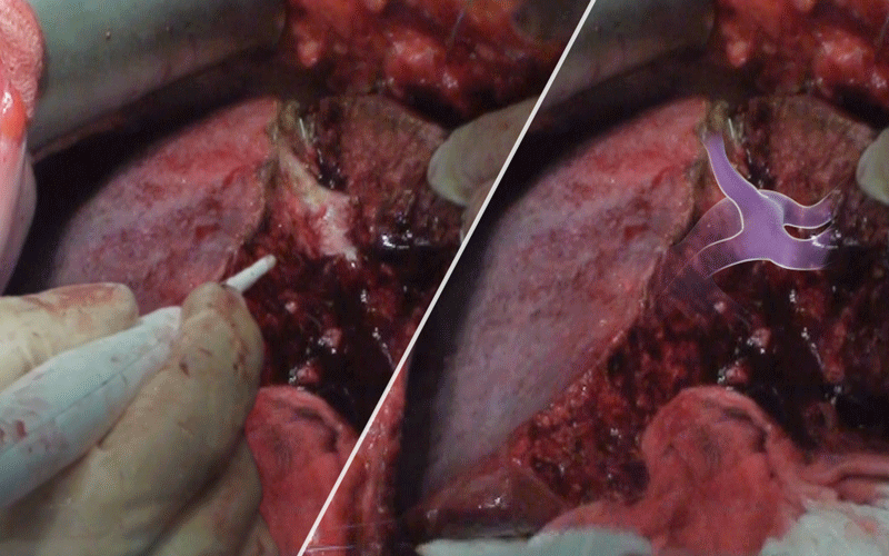 Liver transection technique: Water-jet dissection