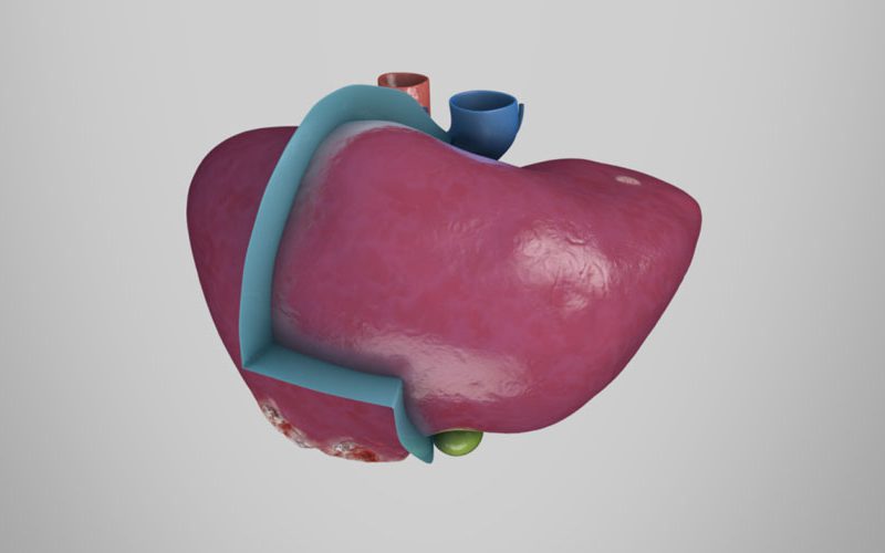 Extended right hepatectomy with multiple wedge resections