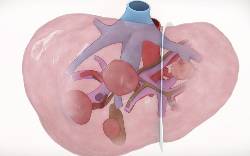 Laparoscopic left lateral sectionectomy