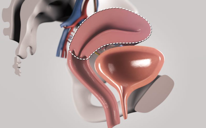 Total Laparoscopic Hysterectomy