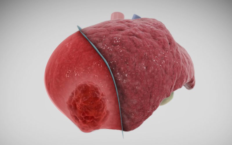 Laparoscopic right posterior sectionectomy