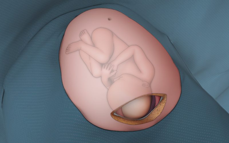 Primary vertex Cesarean section