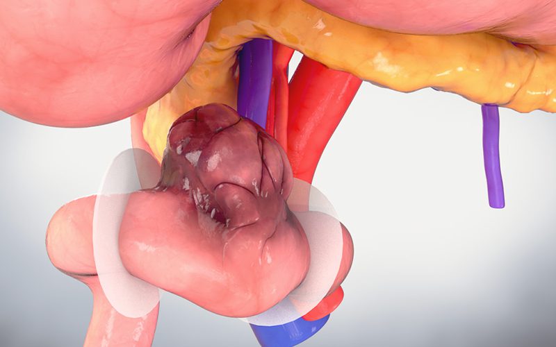 Segmental duodenal resection