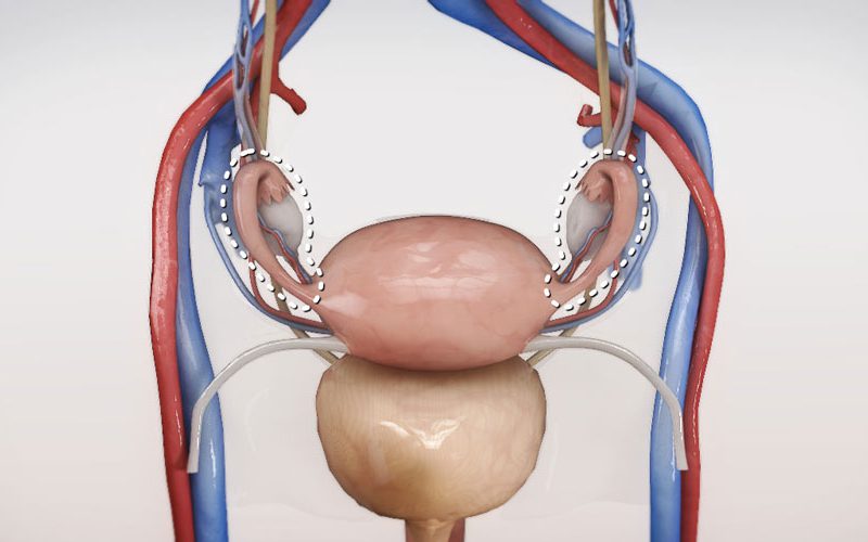 Laparoscopic bilateral salpingo-oophorectomy