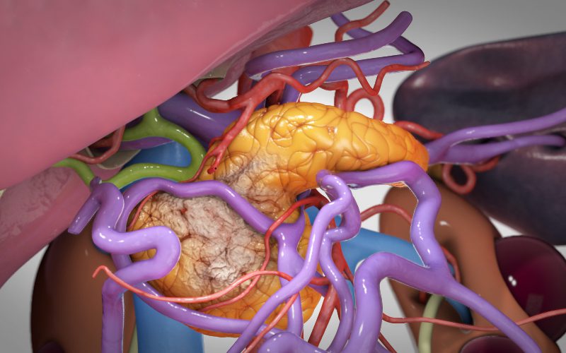 Total pancreatectomy with long portal vein reconstruction