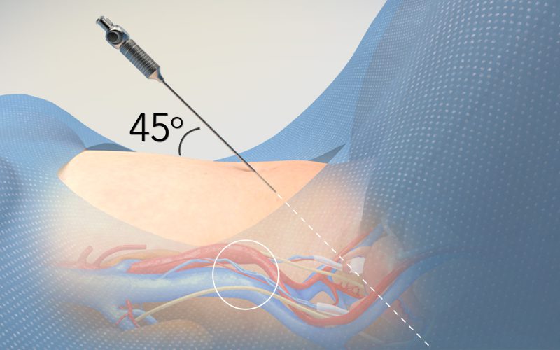 Abdominal Entry in Laparoscopic Gynecologic Surgery