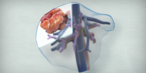 Segment VII/partial segment VIII liver resection