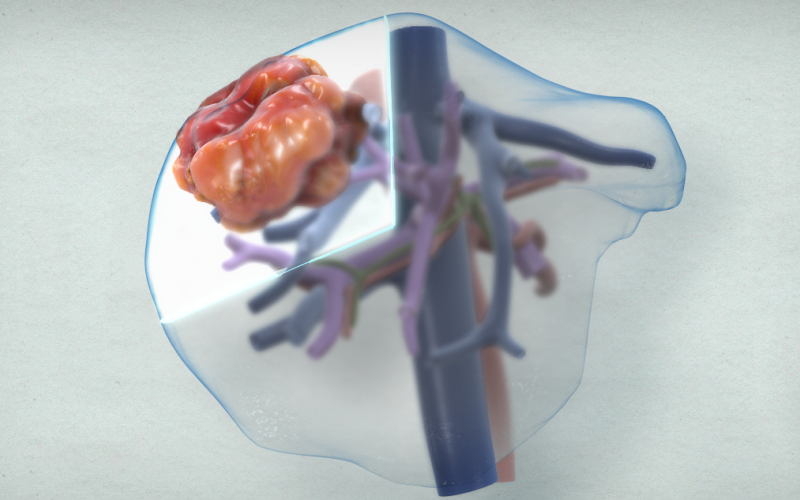 Segment VII/partial segment VIII liver resection