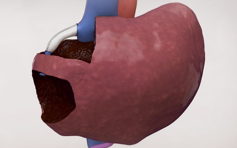 Segment II and IVa resection