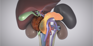 Whipple with extended right hepatectomy and right nephrectomy (Part I)