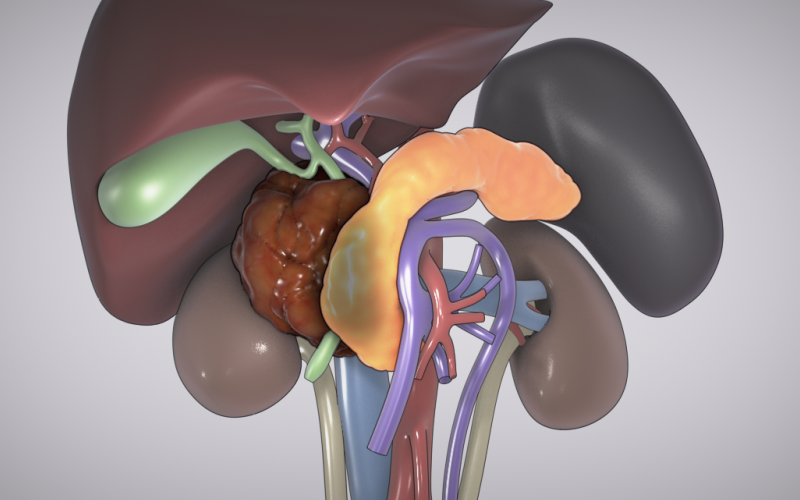 Whipple with extended right hepatectomy and right nephrectomy (Part I)